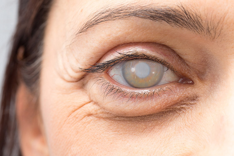 Что такое катаракта и как ее лечат